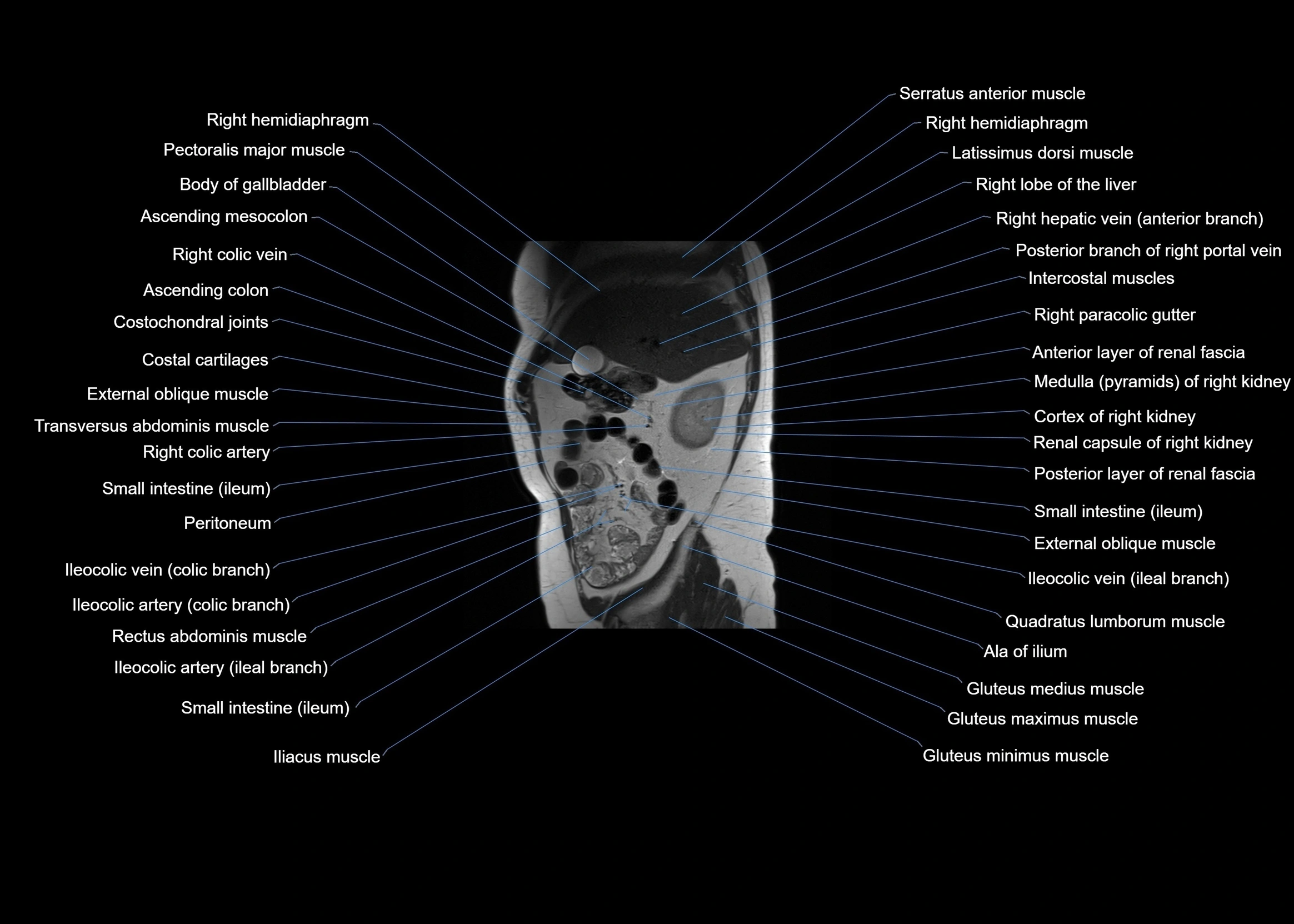 MRI abdomen sagittal cross sectional anatomy  radiology  image-img-00001-00018.webp